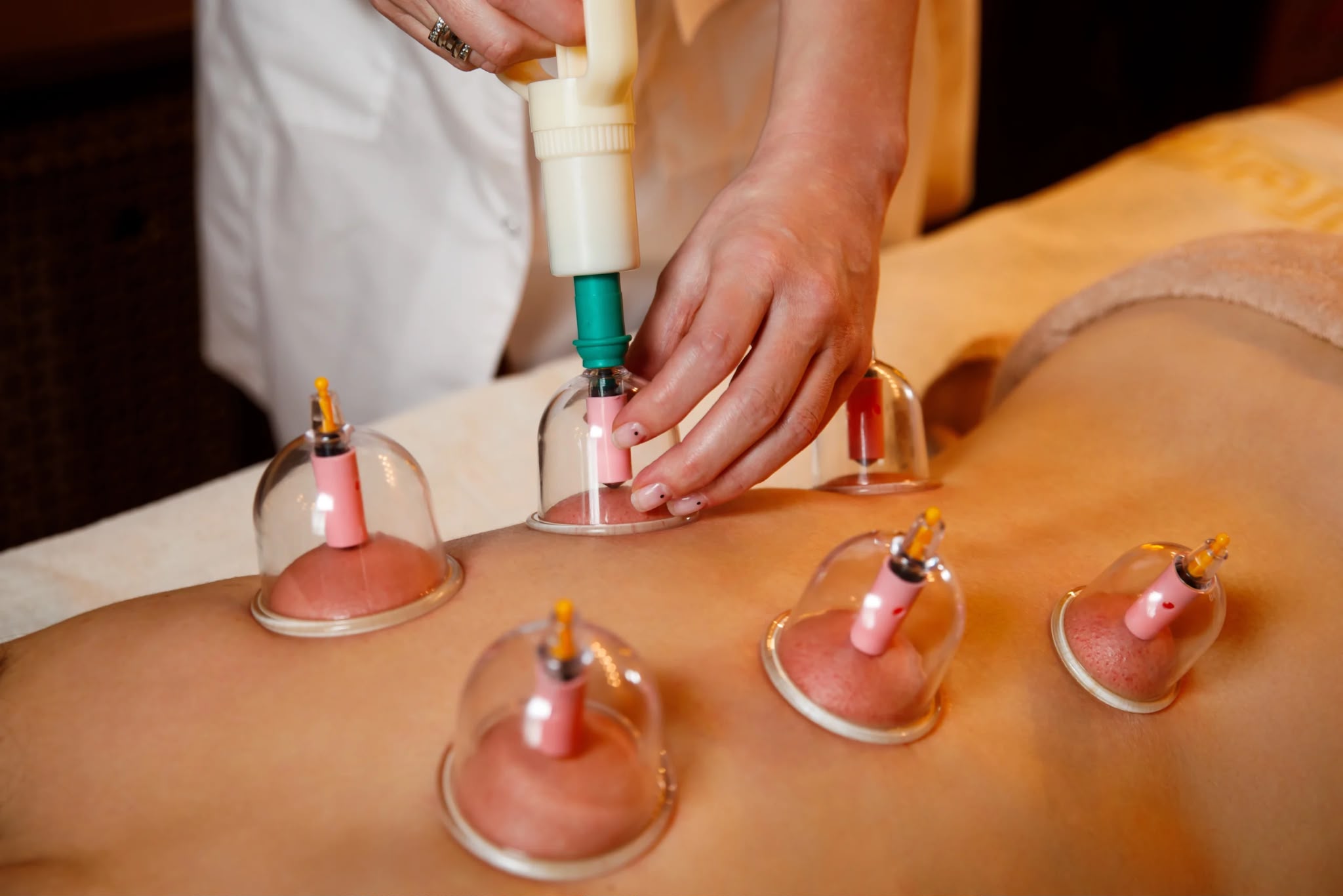 Cupping & Hijama